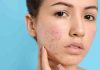5 nutrients to avoid acne and breakouts during monsoon