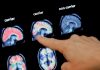 New Alzheimer’s drugs offer hope for bleak diagnosis but remain out of reach in UK | Science & Tech News