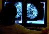 Project launched to bust myth breast cancer is ‘white person’s disease’ | Science & Tech News