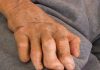 Leprosy is on the rise in the US and could be endemic in Florida, report says | US News