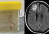 Live worm found in woman’s brain in world-first discovery | World News