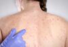 Measles cases rise globally: Know 5 signs and symptoms