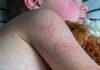 Measles cases worldwide almost double in a year – as England faces measles ’emergency’ | World News