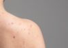 Shoulder acne: Causes and home remedies