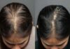 Is alopecia the same as hair loss? Know the difference