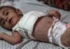 Dangerous skin diseases spreading among children in Gaza | Israel-Palestine conflict News
