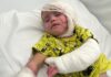 ‘She couldn’t move her mouth’: Baby suffers burns on more than half her body in Israeli airstrike | World News