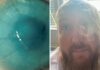Battery acid attack victim reveals how donated placenta treatment saved his eye | UK News