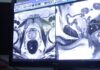 Doctor leading new screening trial warns of ‘sharp rise’ in prostate cancer if disease not detected earlier | Science, Climate & Tech News