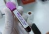 Why prostate cancer is expected to be left as the only major cancer without national screening | Science, Climate & Tech News