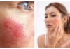 Skin allergies: Why they return and how to restore your skin barrier